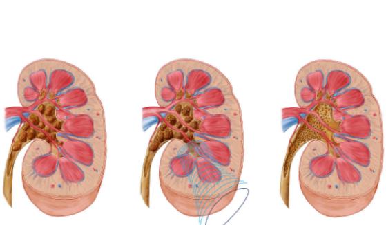 哪種腎結石好碎石 碎腎結石用什么碎