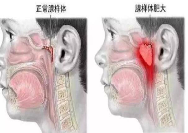 腺樣體肥大一定要做手術嗎 看臨床表現及藥物治療反應