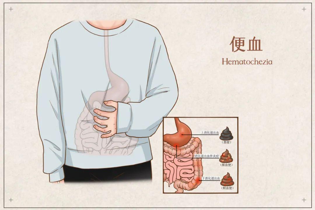 大同肛泰肛腸醫院詳解大便出血咋回事