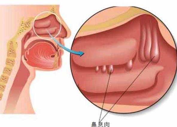 鼻息肉可以做手術嗎 鼻息肉吃藥有效嗎