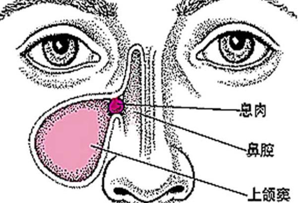 引起鼻息肉的原因有哪些 慢性感染感冒鼻塞飲食個人衛生等