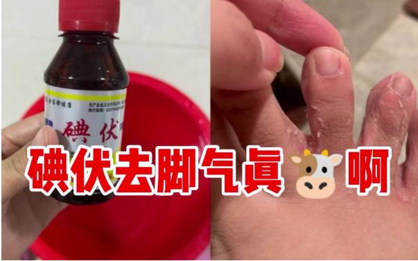 碘伏能治療腳氣嗎？腳氣是缺乏維生素嗎？