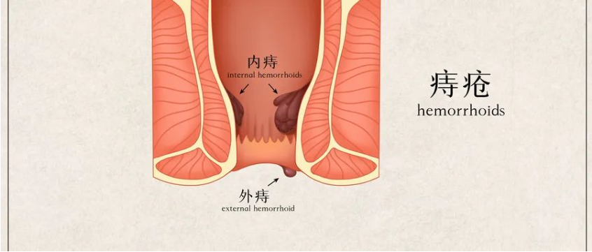 【北京豐益肛腸醫院】痔瘡久拖不治非良策，長期便血容易引發貧血