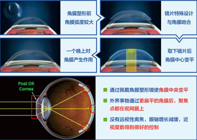 合肥愛爾眼科：角膜塑形鏡只要戴上就行？你想簡單了！