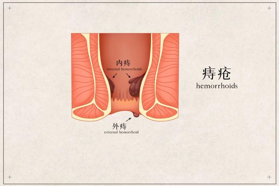 包頭東大專科醫(yī)院詳解痔瘡是如何引起的！對(duì)痔瘡說(shuō)拜拜！