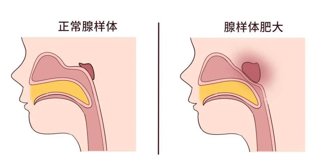 為什么現在患腺樣體肥大的孩子越來越多？聽聽成都民生耳鼻喉醫院怎么說