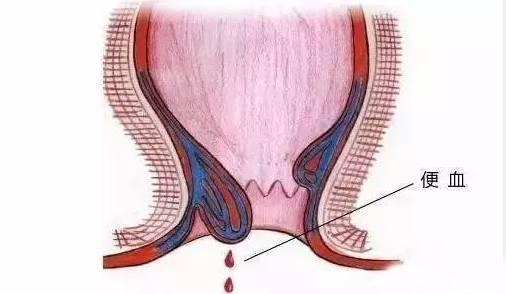 保定東大肛腸醫(yī)院丨肛腸疾病千萬別硬抗，這六種癥狀一定要去醫(yī)院！