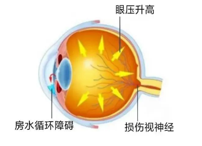 合肥愛爾眼科：青光眼嚴重嗎？它可能會致盲！