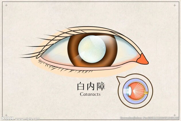 眼前好像蒙了一層霧，是白內(nèi)障嗎？這5大癥狀，轉(zhuǎn)發(fā)給父母自查——福州愛(ài)爾