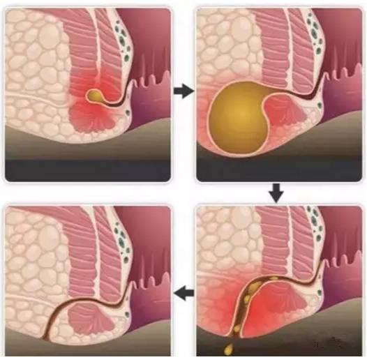 保定東大肛腸醫(yī)院看肛腸疾病怎么樣？這種高發(fā)的肛門疾病發(fā)病率僅次于痔瘡，卻幾乎無法自愈！