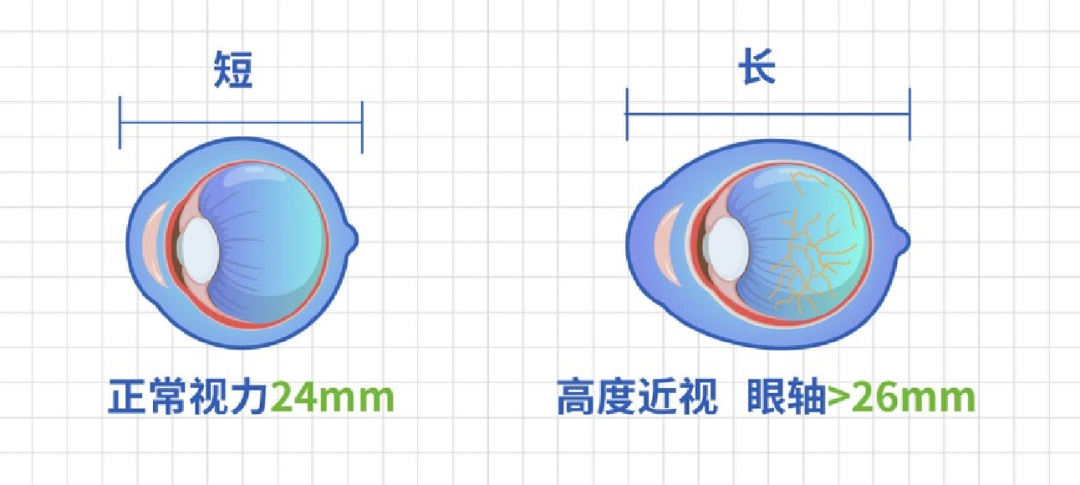 合肥愛爾眼科：盡早做好青少年近視防控，遠離高度近視危害！