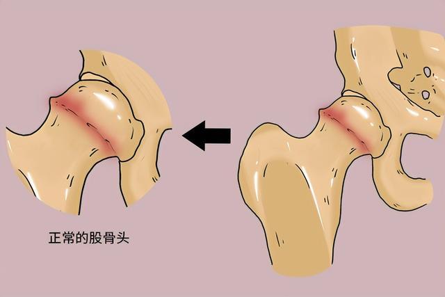 股骨頭壞死平常怎么養？專家推薦天然中成藥