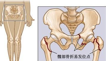 這些股骨頭壞死信號不容忽視，早期股骨頭壞死的保守治療