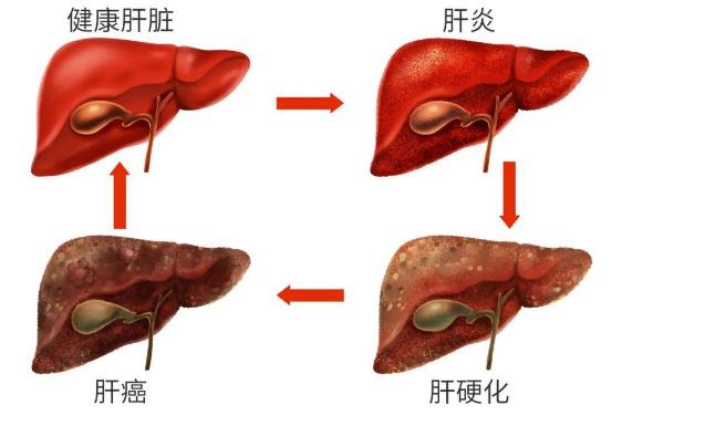 酒精肝是怎么形成的 ？注意事項有哪些？