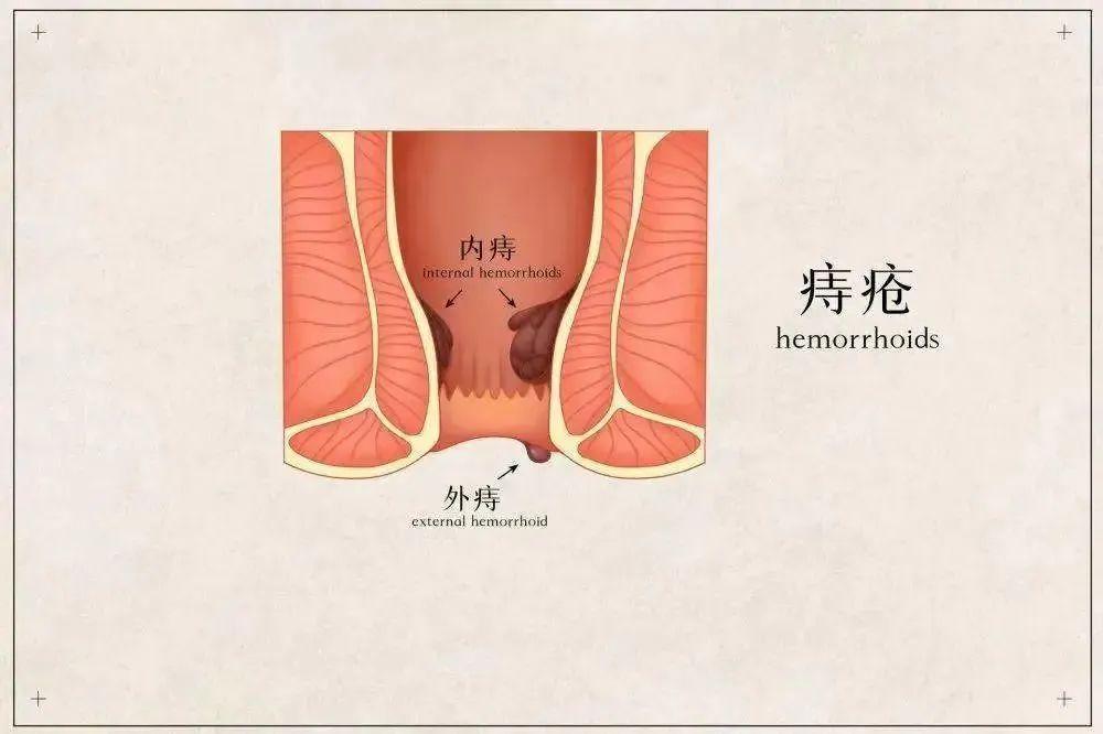 包頭東大肛腸專科醫院詳解痔瘡不痛不癢不用管?這5種痔瘡真的留不得!