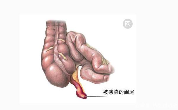 急性闌尾炎保守治療需要幾天 急性闌尾炎保守治療會復發嗎