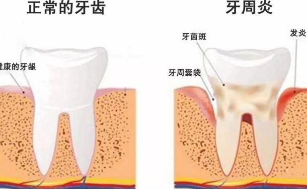 牙周炎檢查？牙周炎小偏方？