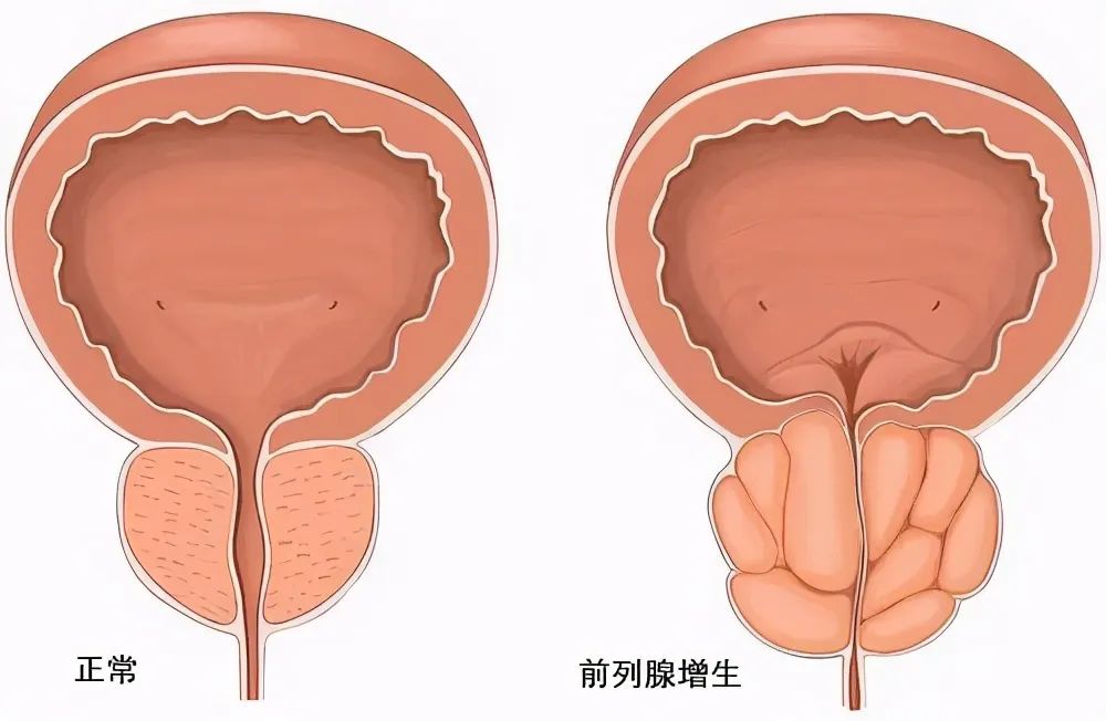 103度水蒸氣“熱死”前列腺病灶Rezūm瑞夢(mèng)輕松解決中老年男性前列腺增生問題