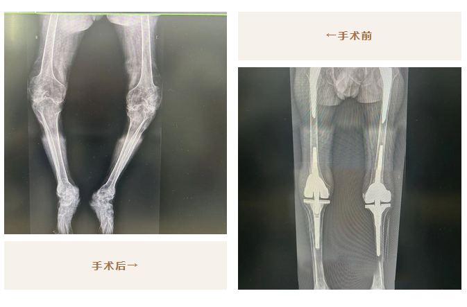 太厲害了！我院骨科助力26年不能站立的他，重新行走！