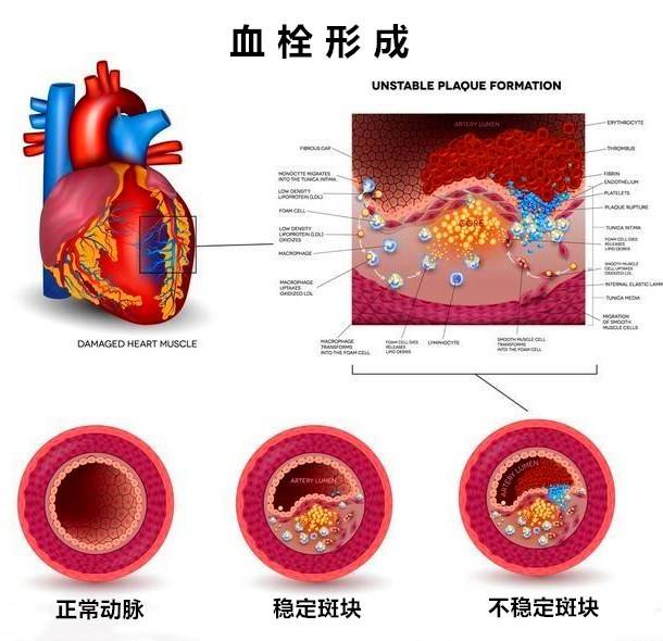 腦梗、頭暈、眼黑總是反復？血脈通栓化斑方就能調理！