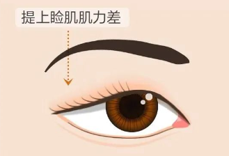 合肥愛爾眼科醫(yī)院：上瞼下垂＝眼皮松弛？其實真相是……