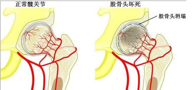 慎用激素藥！激素導致股骨頭壞死不要怕，通血生骨方純中藥調理，從根源治療！