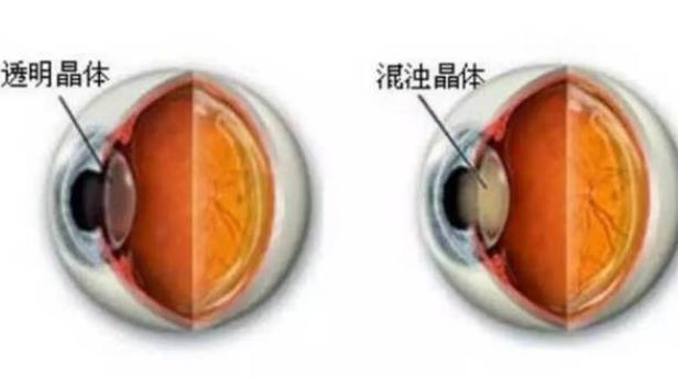 白內障后期會失明嗎 外傷白內障會失明嗎