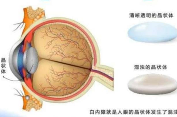 白內障有哪些并發癥 視力色覺改變青光眼失明