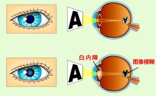 白內障嚴重了會怎么樣 眩光色覺屈光改變眼睛敏感度視力下降