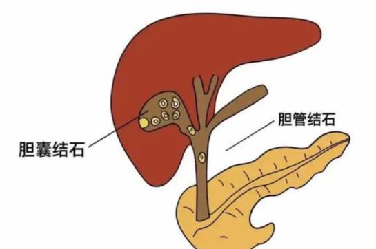 膽結石是哪里痛 膽結石痛怎么緩解