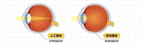 遇到這些眼睛問題要重視！合肥愛爾專家分享—父母眼健康小知識