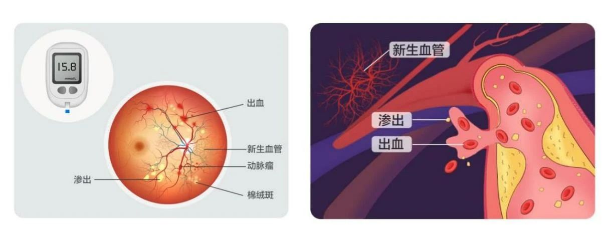 【合肥愛爾】得了糖尿病，為什么醫生讓我看眼科？