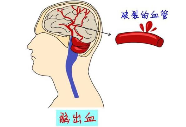 腦出血是什么原因導致 不良生活習慣高血壓顱腦外傷