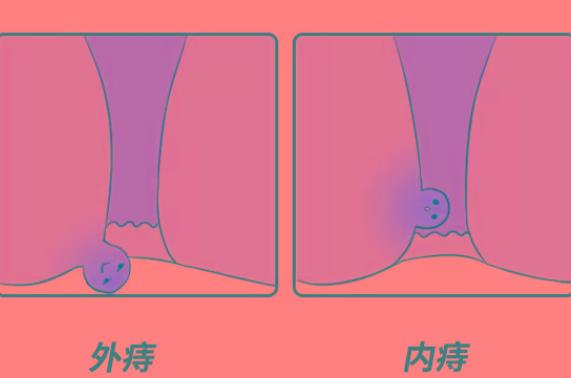 哺乳期能用痔瘡膏嗎 麝香痔瘡膏哺乳期能用嗎